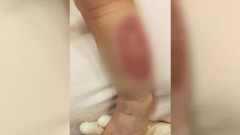 驚！母抱嬰買湯麵　竟致女嬰小腿「二度燙傷」