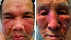 接種後「臉紅腫冒膿！」 美大學研究曝：莫德納「罕見副作用」